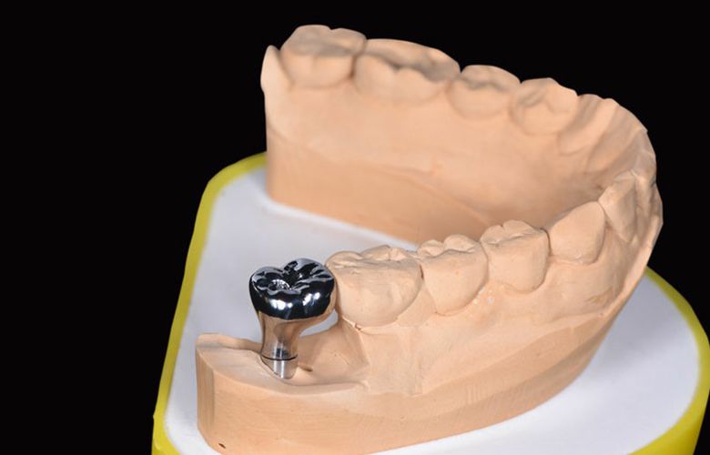 Дизайн-проект имплантата