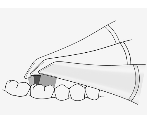 Внутриротовые сканеры играют важную роль в детской стоматологии.