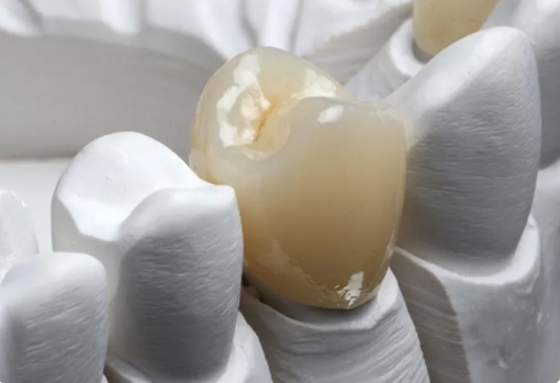 Распространенные типы зубных коронок и их характеристики