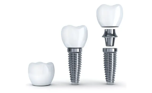 Преимущества дентальной имплантации