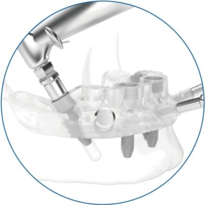 Цифровая имплантационная стоматология