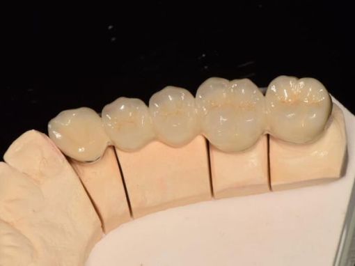 Реставрация зуба циркониевой коронкой